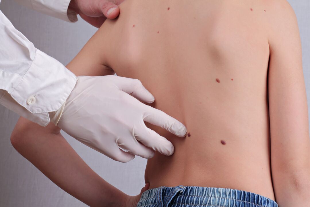 Dermatologs veic pacienta klīnisko pārbaudi ar papillomas uz ķermeņa