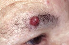 Papilloma uz uzacīm