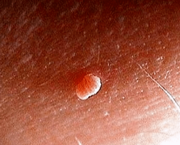 Papilloma uz ķermeņa