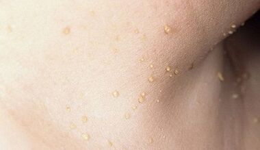 papilomatozes attīstības risks uz kakla