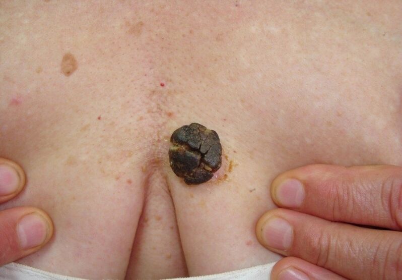 keratoma uz cilvēka ķermeņa