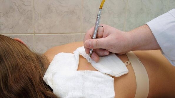 papilomas elektrokoagulācija uz muguras